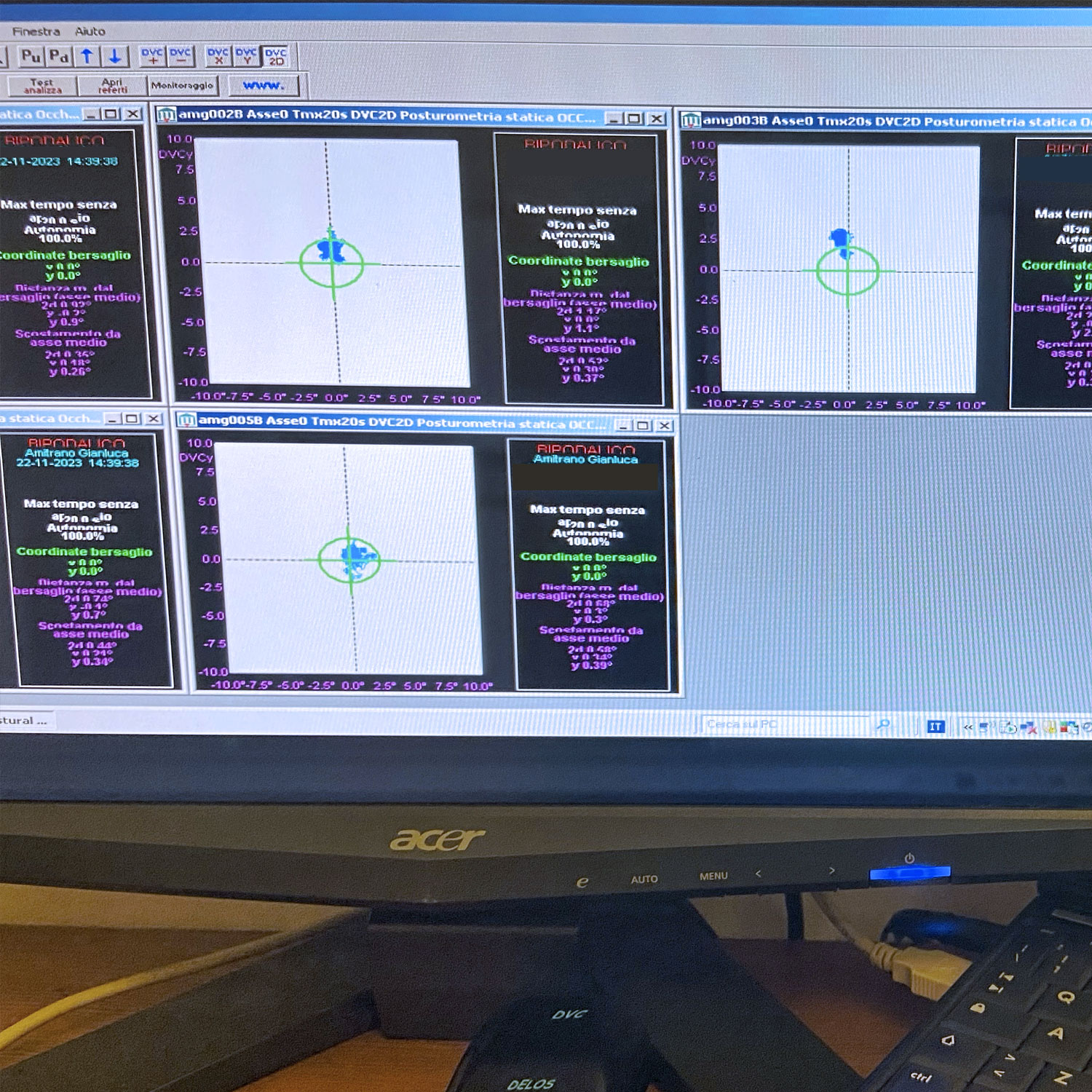Esame posturografico: i tracciati della stabilometria sul monitor dello studio